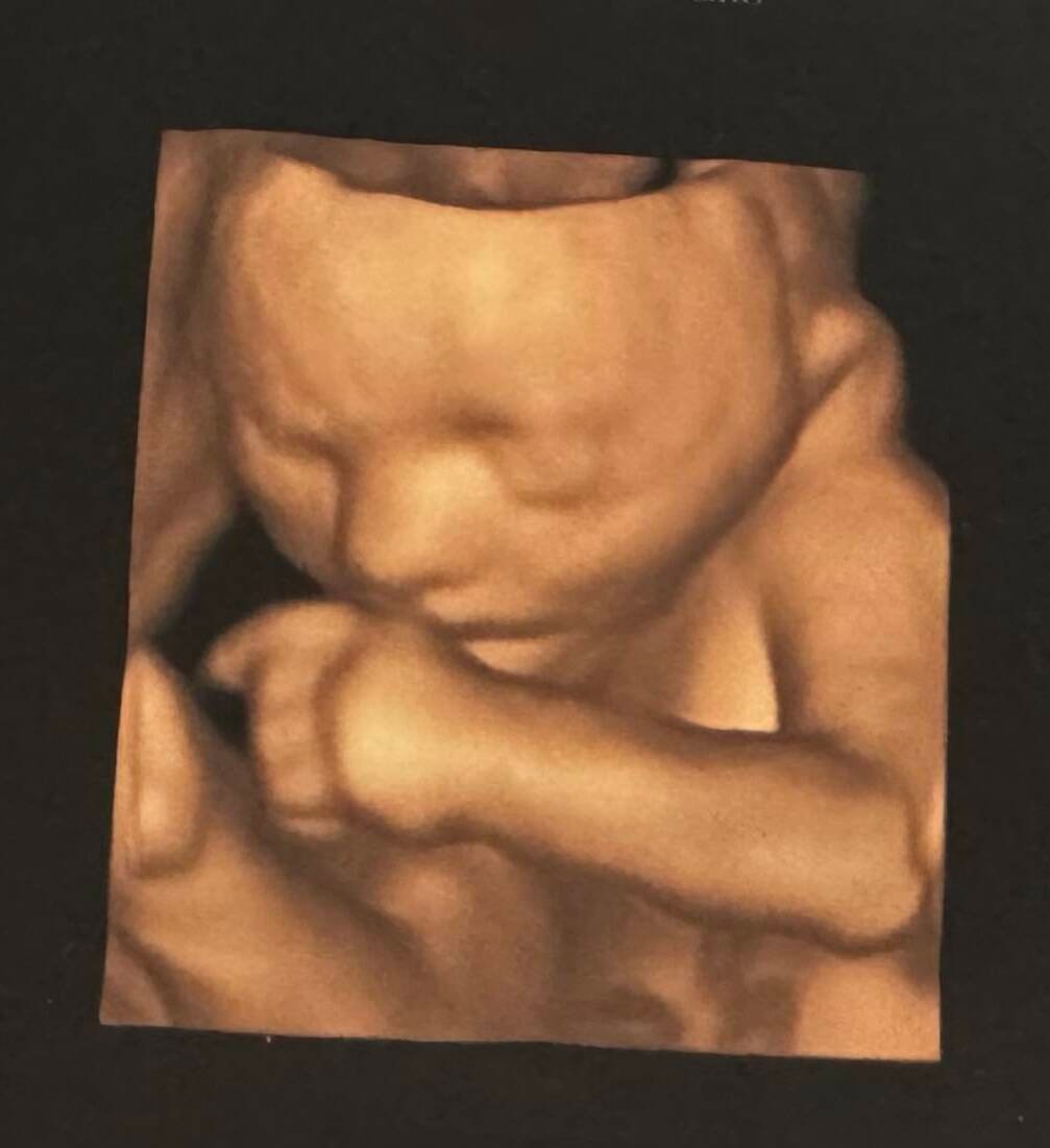 Obstetrik ( Gebelik) Ultrasonu